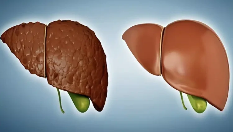 Λιπώδες ήπαρ: Το διατροφικό πλάνο που «καίει» το λίπος στο συκώτι και βοηθά σε ταχεία απώλεια βάρους
