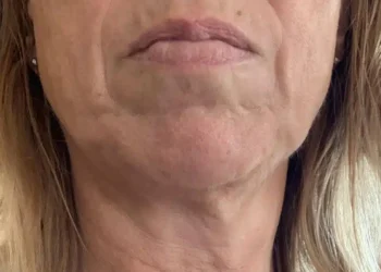 Ενδοκρινολόγος αποκαλύπτει τα δύο φαγητά που κάνουν το δέρμα να γερνά πιο γρήγορα