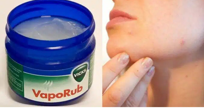 Δείτε 10 απίστευτες ασυνήθιστες χρήσεις για το διάσημο Vicks VapoRub