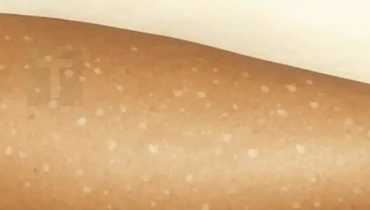 Λευκές κηλίδες στο δέρμα: Ποιες ελλείψεις βιταμινών μπορεί να είναι η αιτία;