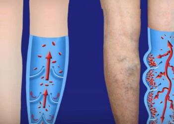 Κουραστήκατε από την κακή κυκλοφορία και τους κιρσούς; Δοκιμάστε αυτά τις 6 αποτελεσματικές συμβουλές