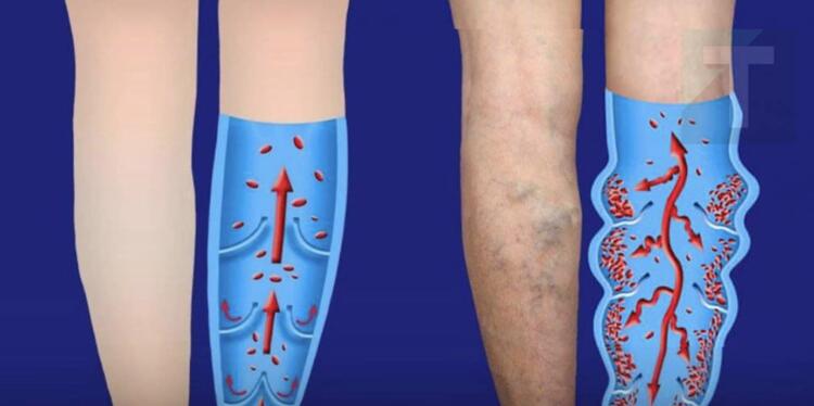 Κουραστήκατε από την κακή κυκλοφορία και τους κιρσούς; Δοκιμάστε αυτά τις 6 αποτελεσματικές συμβουλές