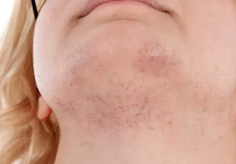 women chin hair 183408753 770x533 1 jpg
