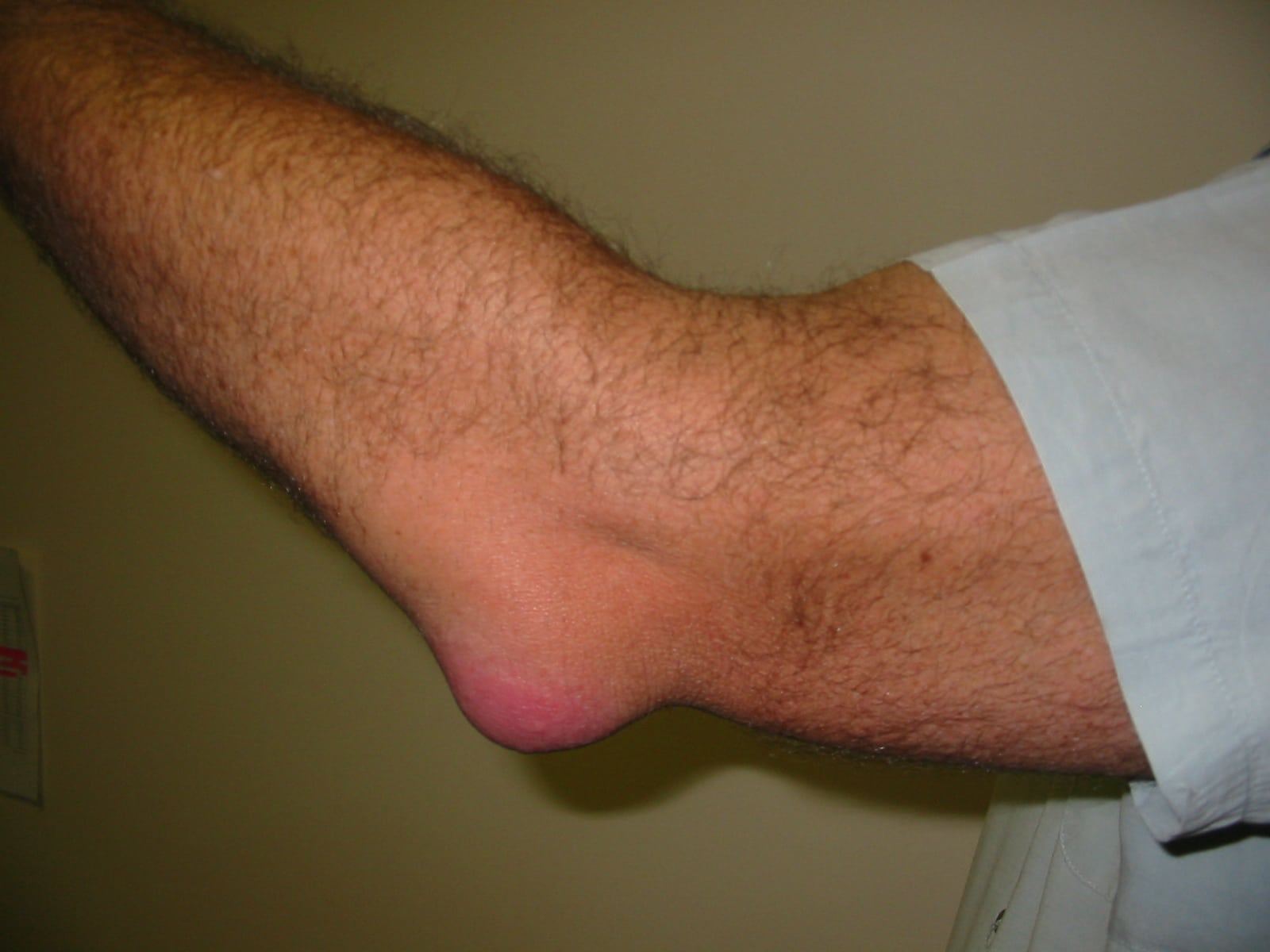 bursitis elbow wc
