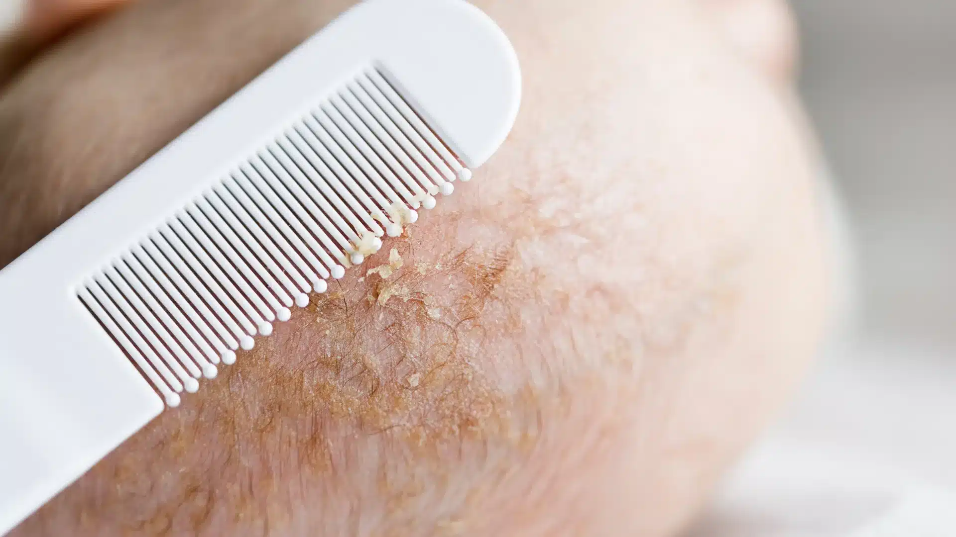 cradle cap.d0bnd ek z1klen2