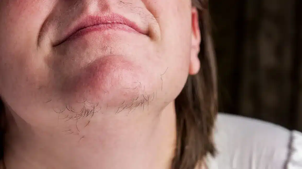 hirsutism of the chin body4
