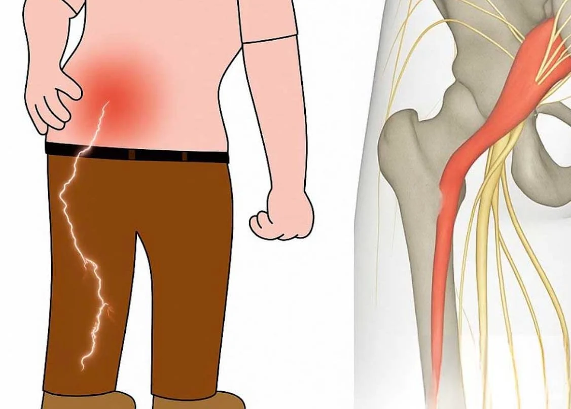 3 ασκήσεις για την ανακούφιση από τον ισχιαλγικό πόνο στο πόδι: πρακτικές και αποτελεσματικές