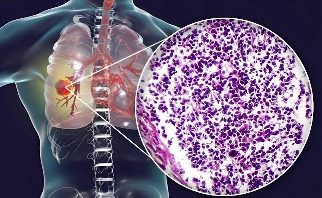 Ο αόρατος κίνδυνος – Τι κοινό υλικό κουζίνας συνδέεται με καρκίνο πνεύμονα – Προσοχή στο σπίτι σας