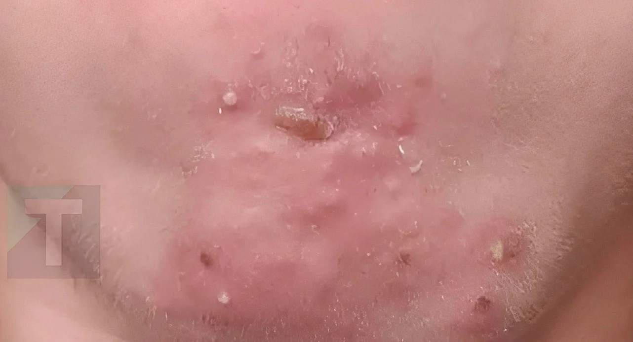 Έβγαινα με μια γυναίκα που γνώρισα στο σουπερμάρκετ και αφού τελικά πήγα μαζί της ξύπνησα με αυτά στο πρόσωπό μου. Τι είναι αυτό;