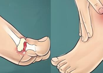 Ποιες τροφές ανεβάζουν επικίνδυνα το ουρικό οξύ και τι πρέπει να προσέχετε