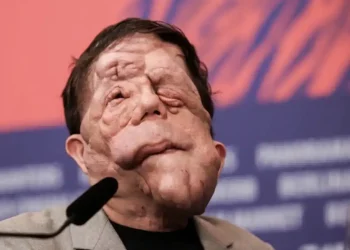 Χαμός στα Όσκαρ: Πασίγνωστος ηθοποιός εμφανίστηκε με αυτό το πρόσωπο και… πάγωσαν όλοι – Η σπάνια αρρώστια που τον «χτύπησε»