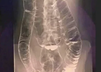 Χρόνια δυσκοιλιότητα – Μια σιωπηλή απειλή για την υγεία του πεπτικού συστήματος