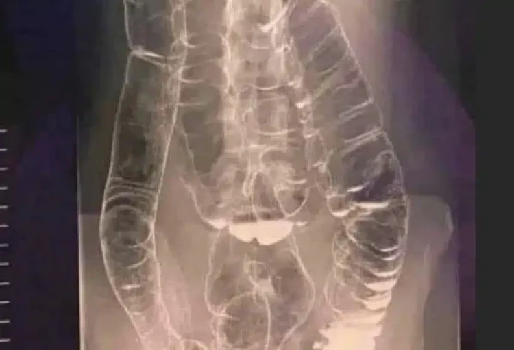 Χρόνια δυσκοιλιότητα – Μια σιωπηλή απειλή για την υγεία του πεπτικού συστήματος